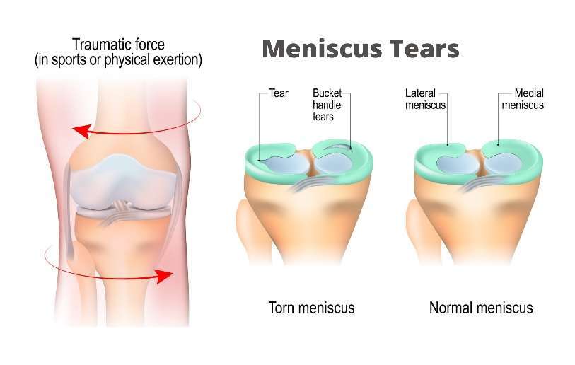 Meniscus injury - Tear